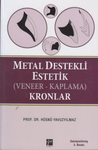 Metal Destekli Estetik (Veneer-Kaplama) Kronlar